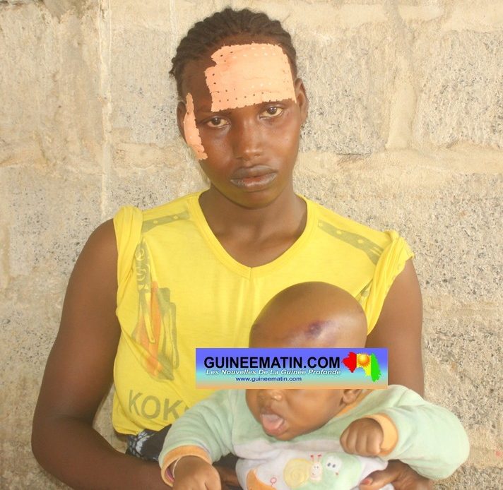 Une nourrice et son bébé blessés à Wanindra (Conakry) : « les agents m’ont accusée de vendre du riz aux manifestants »