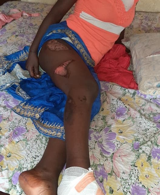 Conakry : Une patronne fait brûler avec un fer à repasser sa jeune domestique à Sangoyah